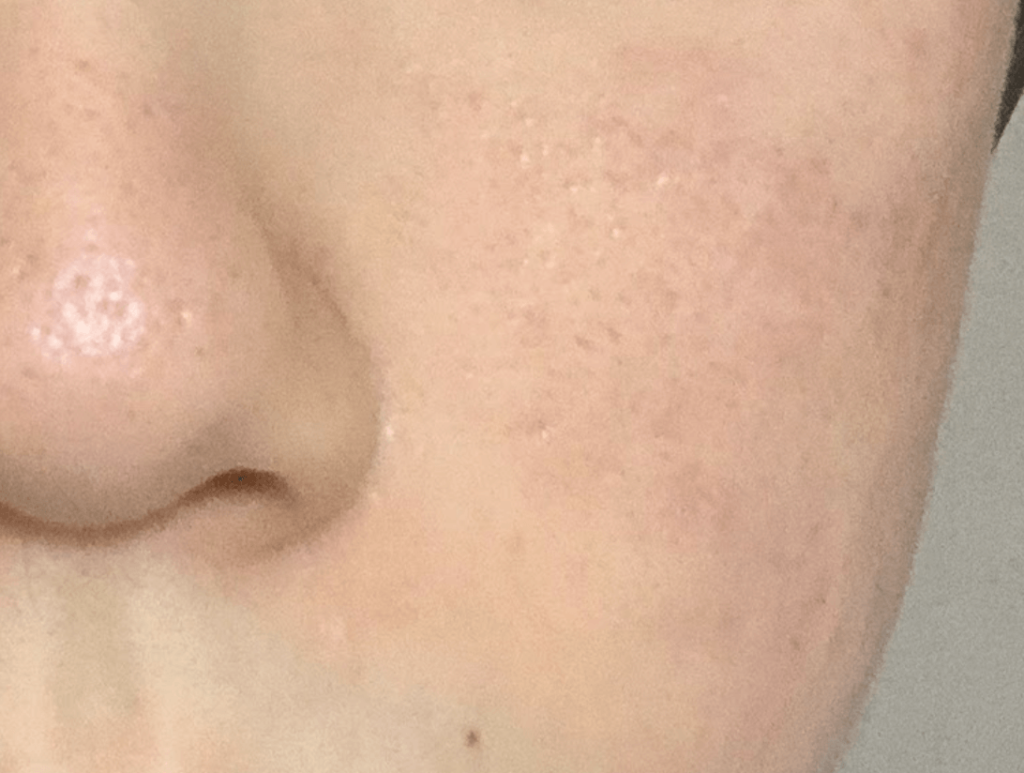 ポテンツァ2回目によるダウンタイム後の効果