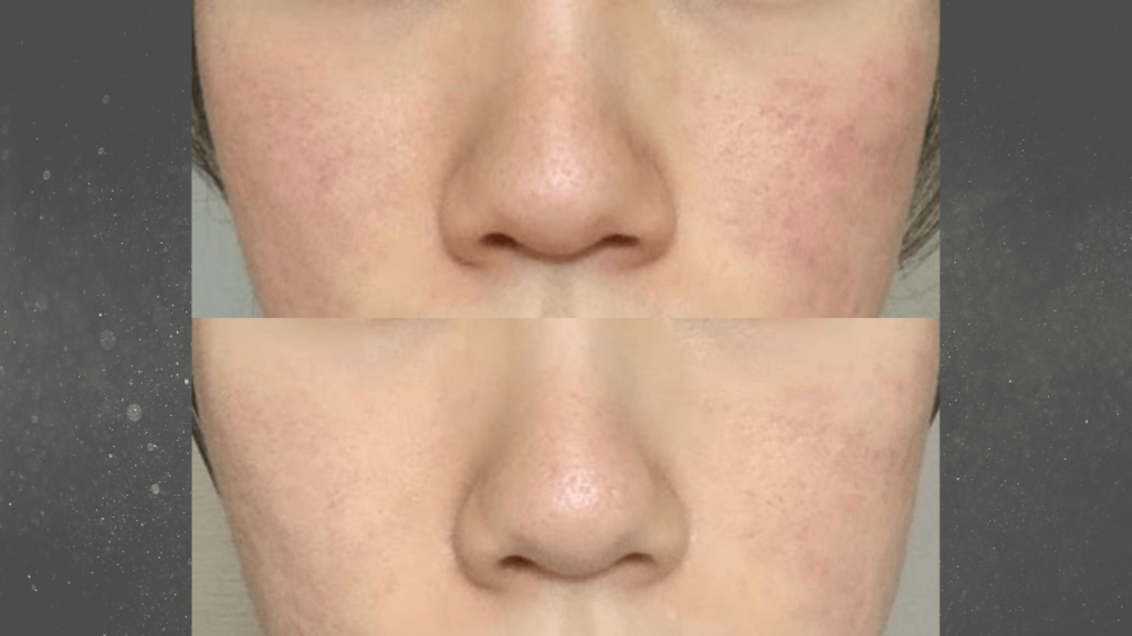 ニキビ跡と毛穴治療の経過