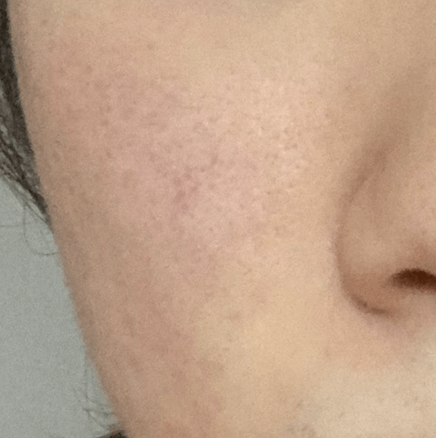 ポテンツァによるニキビ跡の治療効果