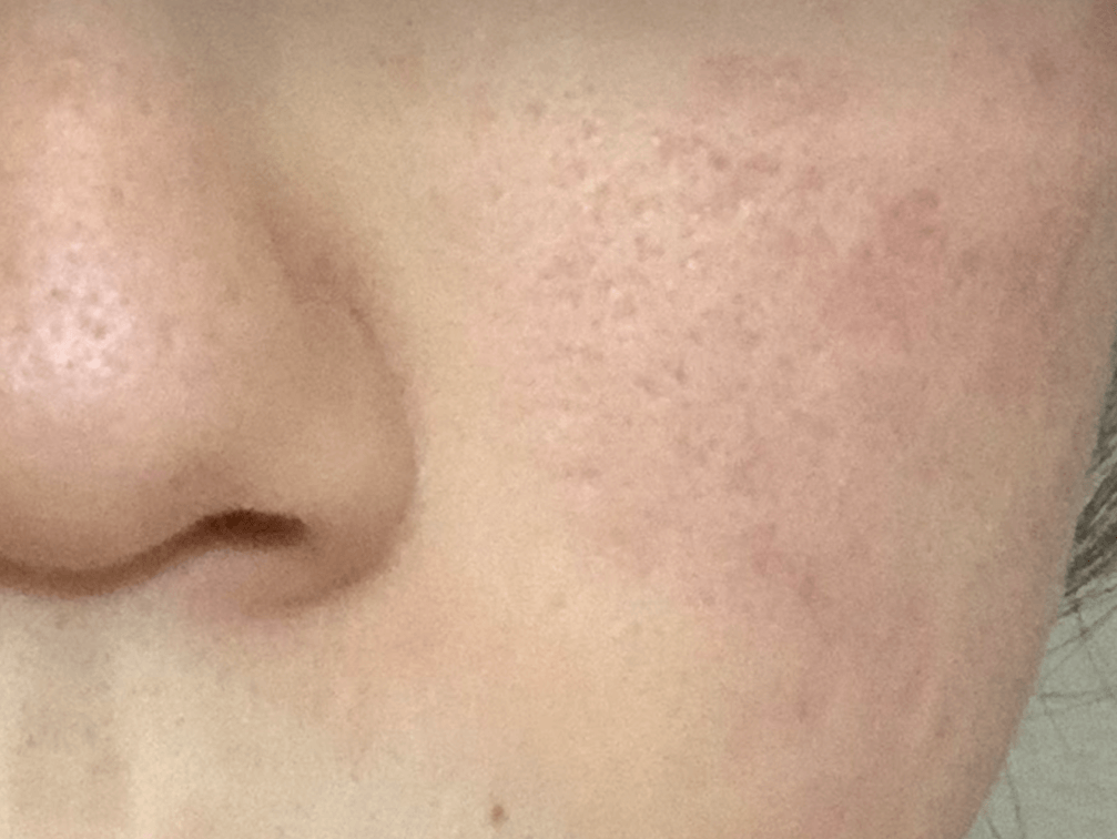 ポテンツァ1回による毛穴や赤みの効果