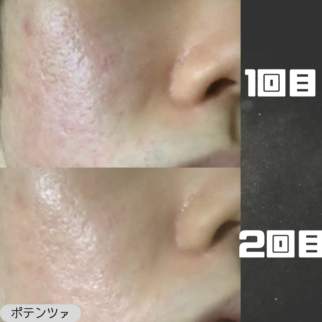 ポテンツァの1回目と2回目の効果を比較した